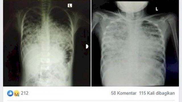 Viral Foto Kondisi Paru-paru Anak 7 Tahun Terinfeksi COVID-19, Begini Faktanya...