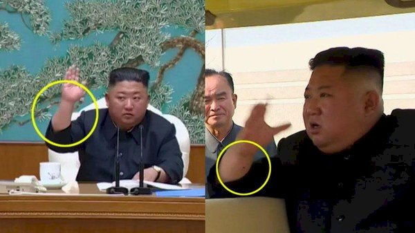 Teka-teki Jahitan Operasi Kim Jong-un Masih Misteri
