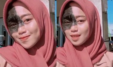 Hijabers Cantik Ini Viral Dibully karena Ada Tanda Lahir, Tapi Siapa Sangka!