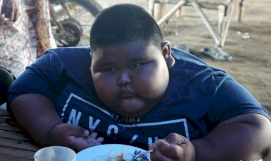 Bocah 7 Tahun Berbobot 101 Kg Asal Karawang Meninggal Dunia