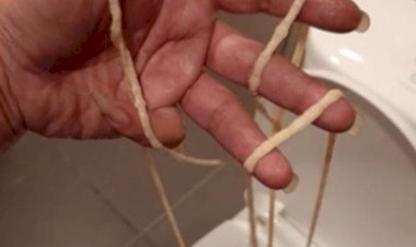 Ngeri, Pria Ini Keluarkan Cacing Pita Sepanjang 10 Meter