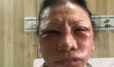 Sedot Lemak Pipi Seperti Ratna Disarankan untuk Wajah Chubby dan Usia Muda 