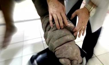 Di Batanghari Jambi Ditemukan 58 Kasus Kaki Gajah