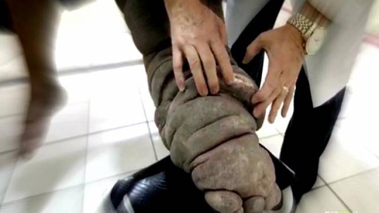 Di Batanghari Jambi Ditemukan 58 Kasus Kaki Gajah