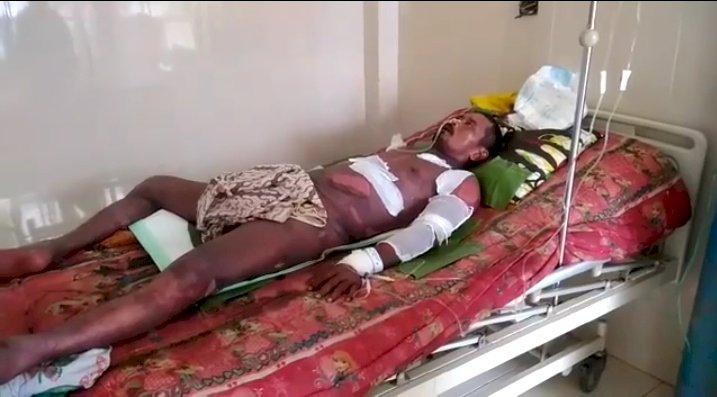 Warga Sengeti Ini Penderita Sindrom Steven Jhonson, Butuh Bantuan Dermawan