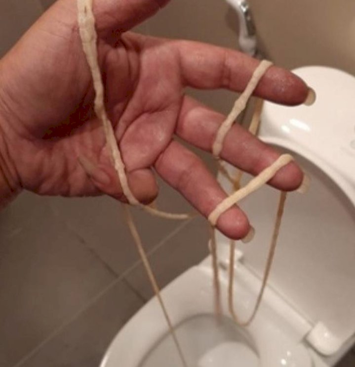 Ngeri, Pria Ini Keluarkan Cacing Pita Sepanjang 10 Meter
